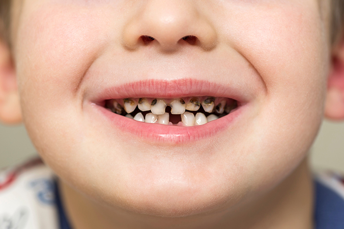 dental-problems-in-children-cavities