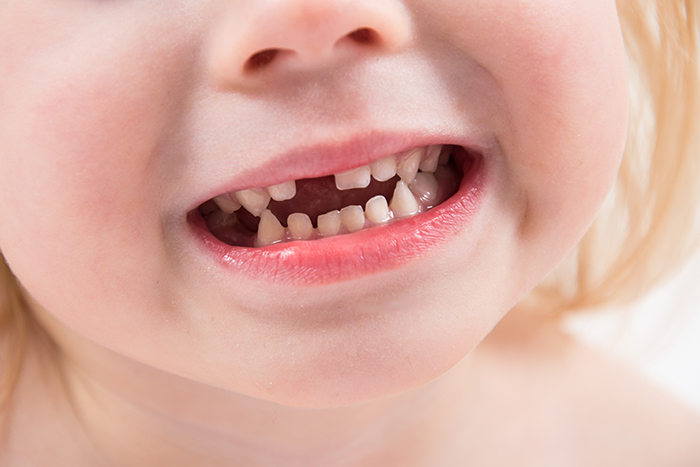 dental-problems-in-children-early-tooth-loss