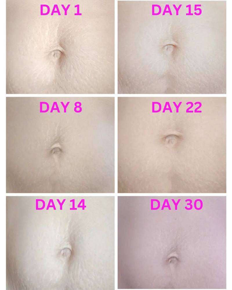 Mama's Choice Stretch Mark Treatment Series Before and After