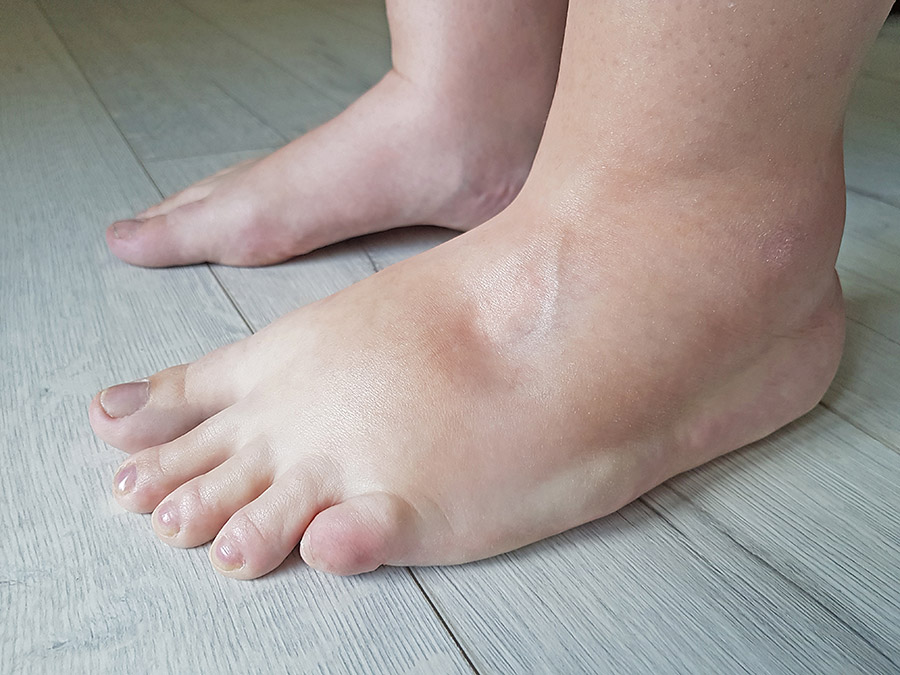 Swollen-feet
