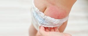 What-to-do-when-diaper-rash-is-bad
