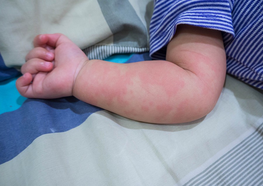 baby-hives