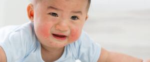 common-baby-rashes