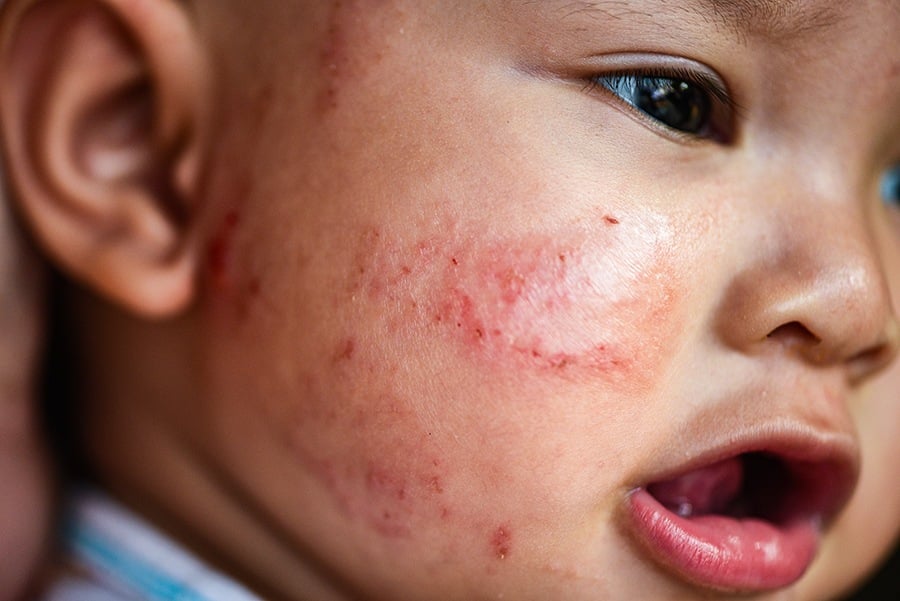 eczema-baby-rash