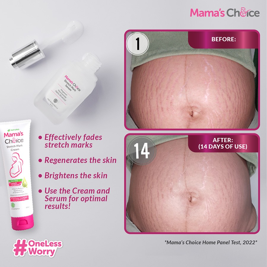 Mama's Choice Stretch Mark Removal Before After
