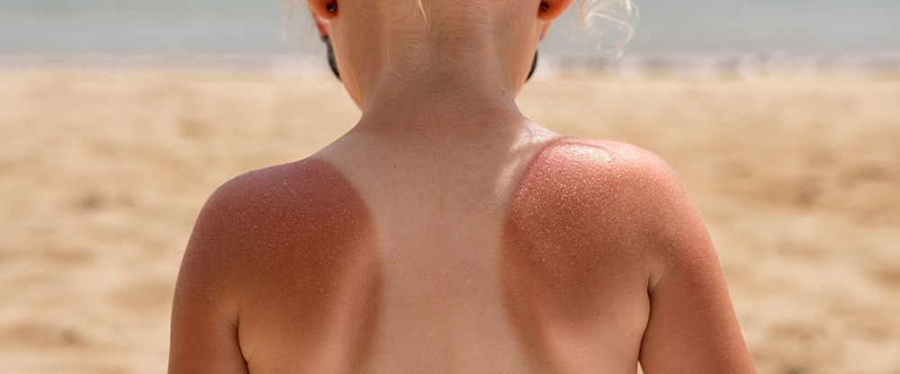 8 NATURAL SUNBURN REMEDIES – TTN Palawan 