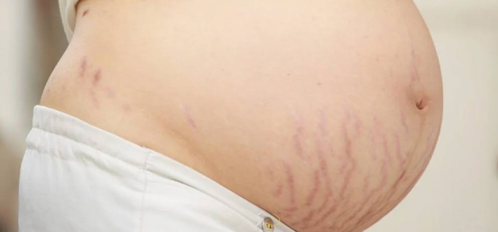 red-pregnancy-stretch-marks