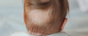 how-to-prevent-baby-hair-loss